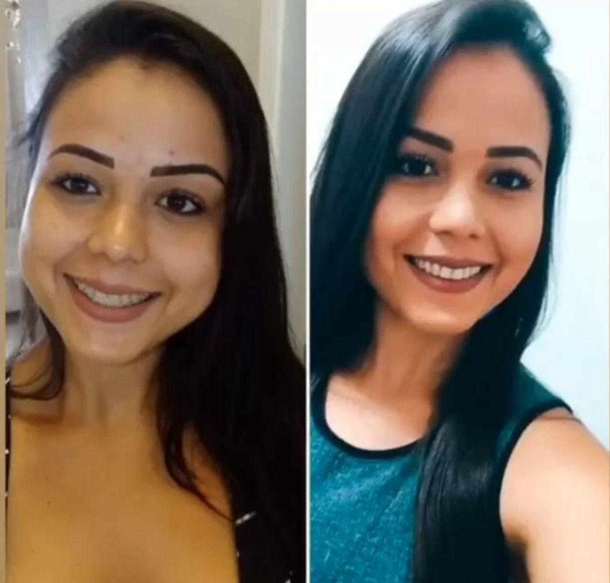 Antes e depois de harmonização facial