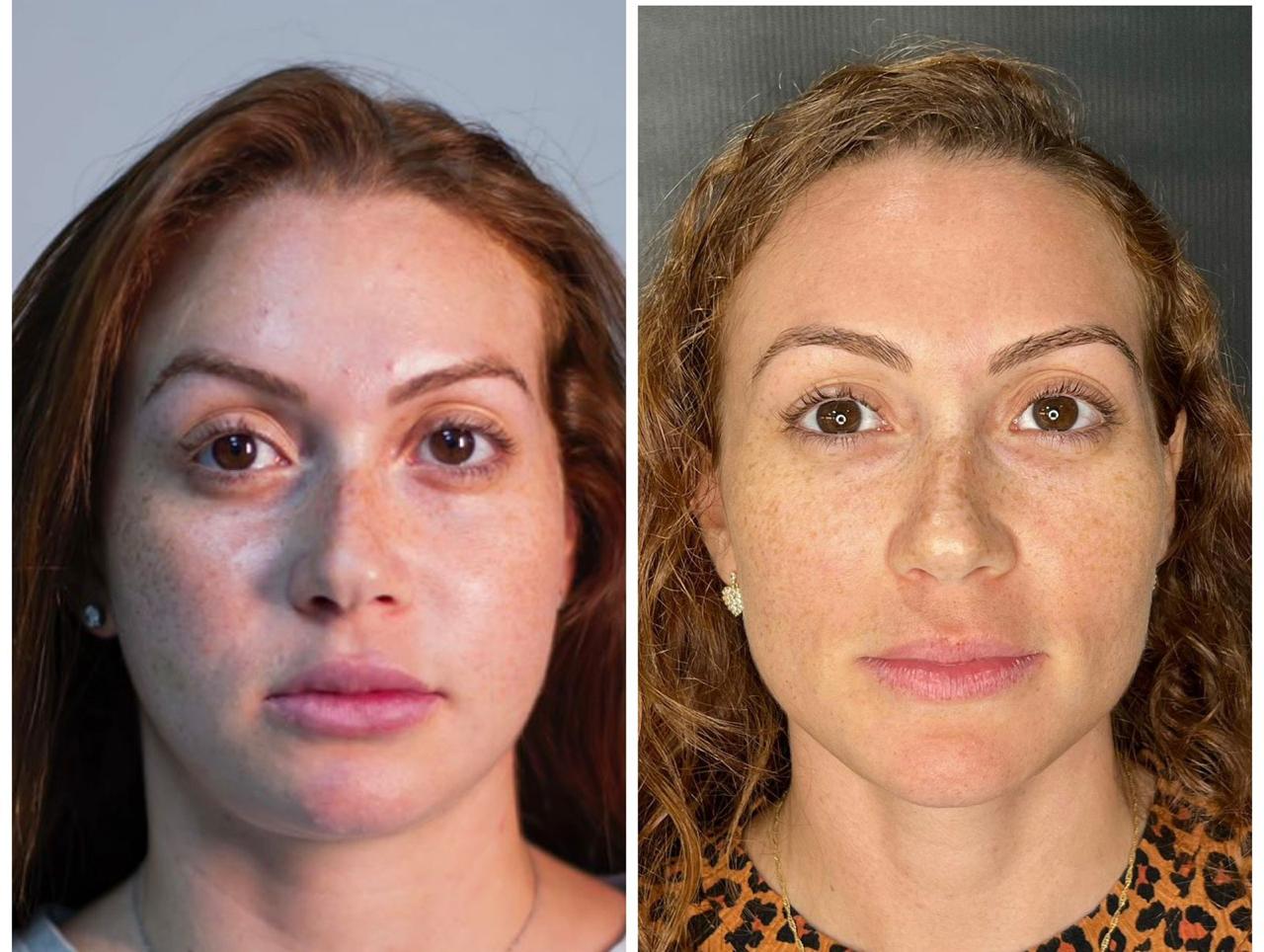 Antes e depois de harmonização facial