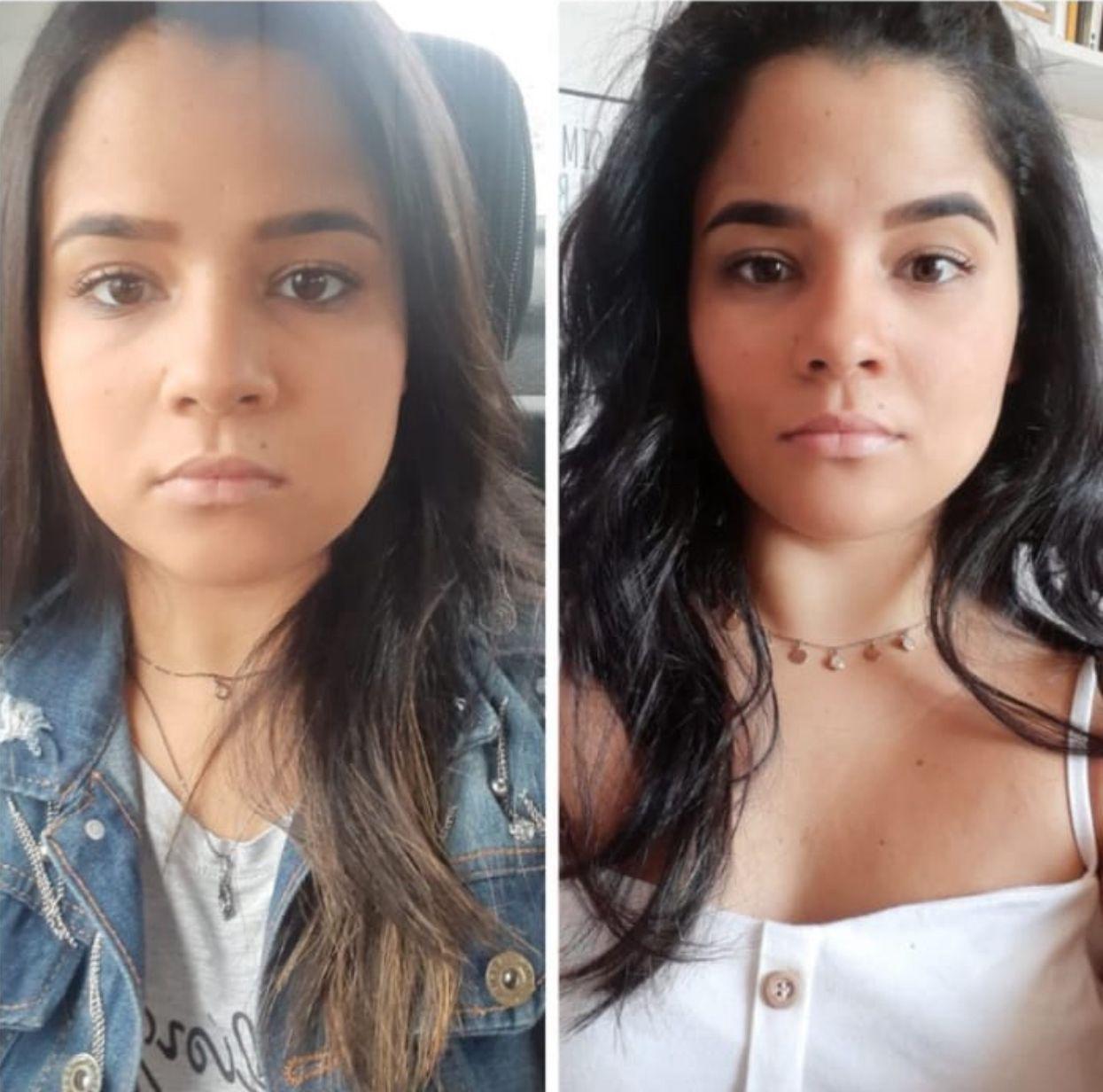 Antes e depois de harmonização facial